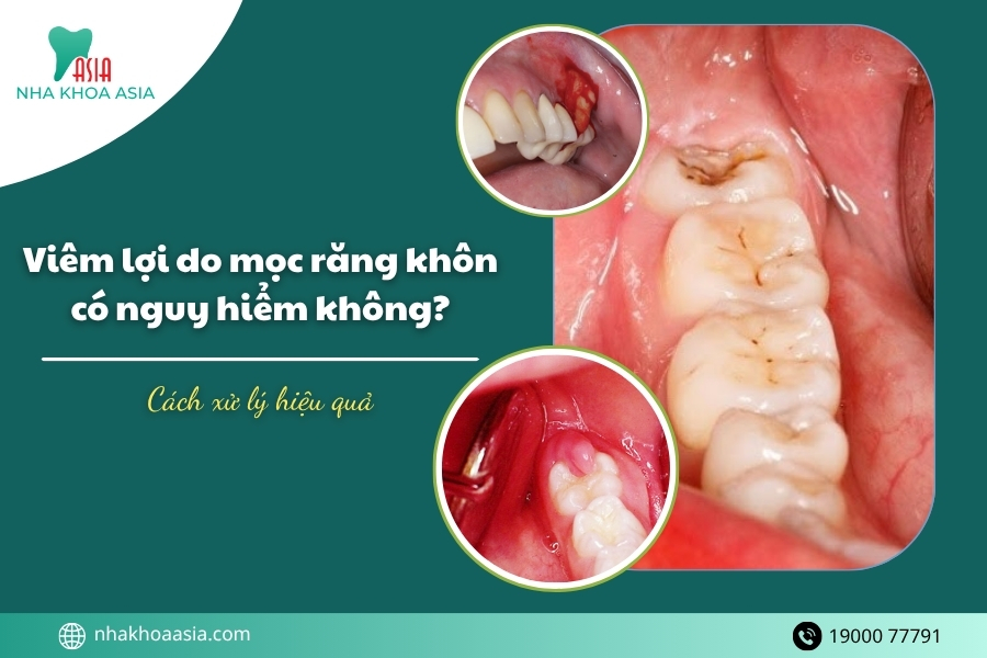 Viêm lợi do mọc răng khôn có nguy hiểm không? Cách xử lý hiệu quả