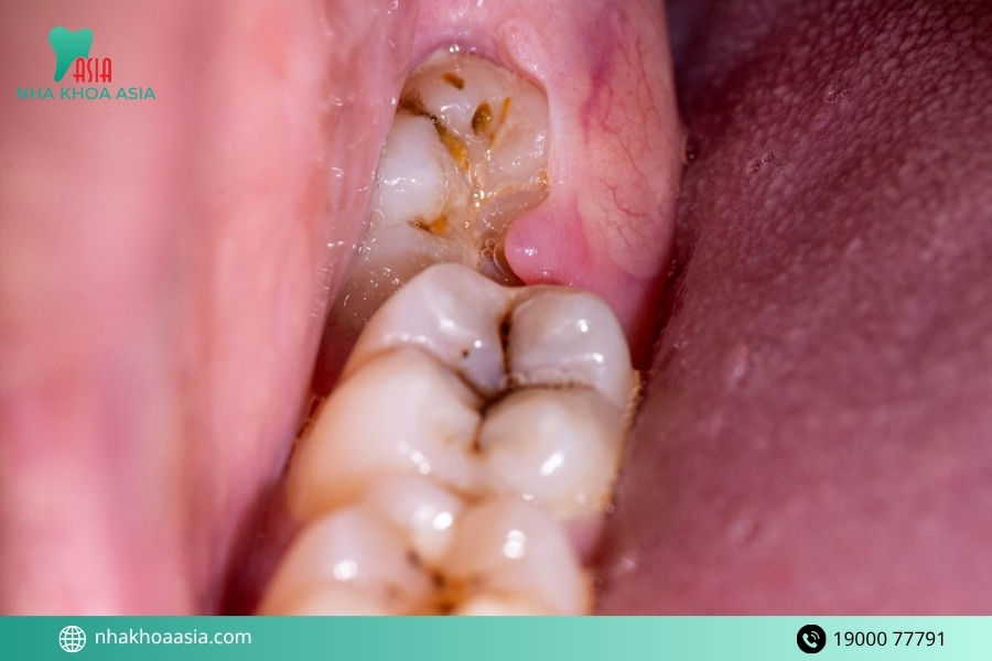 Một số cách giảm đau khi bị viêm lợi do mọc răng khôn trong khi chờ thăm khám