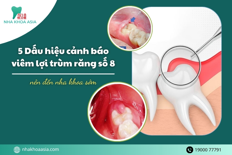 5 Dấu hiệu cảnh báo viêm lợi trùm răng số 8 bạn cần biết