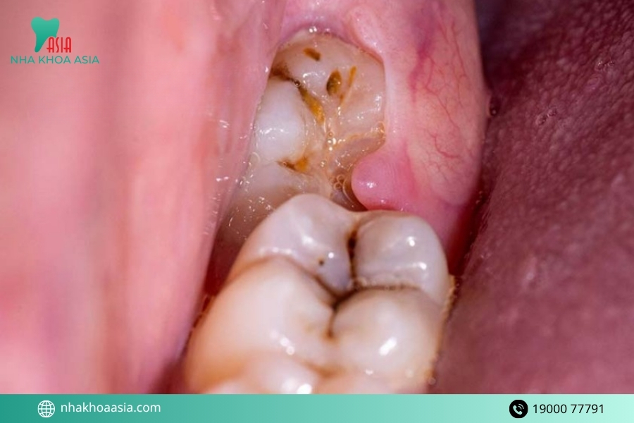 Viêm lợi trùm răng số 8 có điều trị tại nhà được không? Có tự khỏi không?