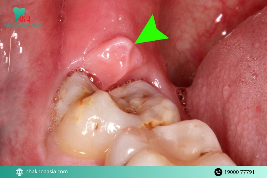 Các phương pháp điều trị viêm lợi trùm răng số 8 tại nha khoa