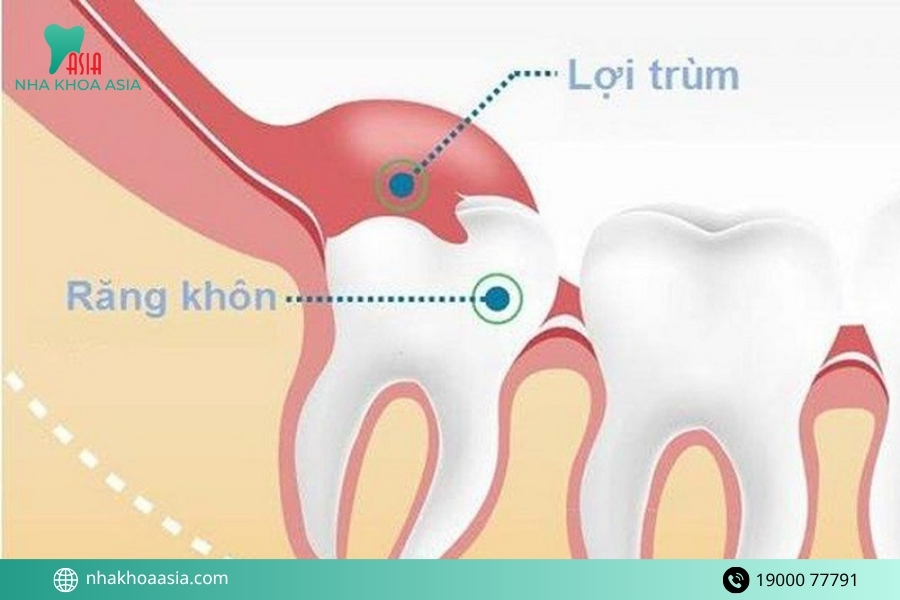 Chi phí điều trị viêm lợi trùm răng số 8