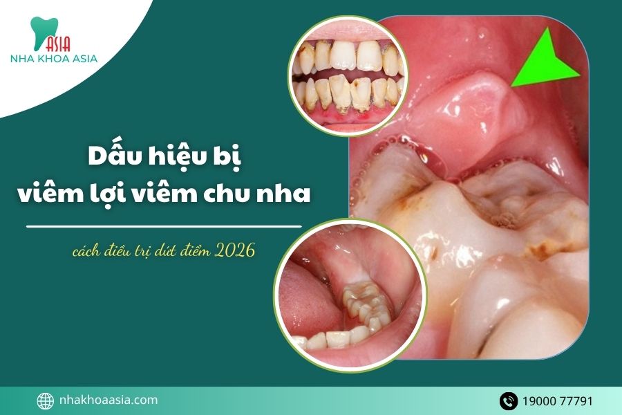 Dấu hiệu bị viêm lợi viêm chu nha và cách điều trị dứt điểm 2026