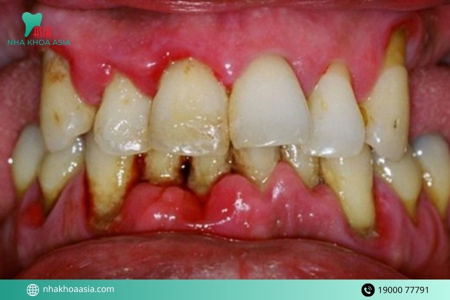 Dấu hiệu viêm lợi viêm nha chu dễ nhận biết nhất