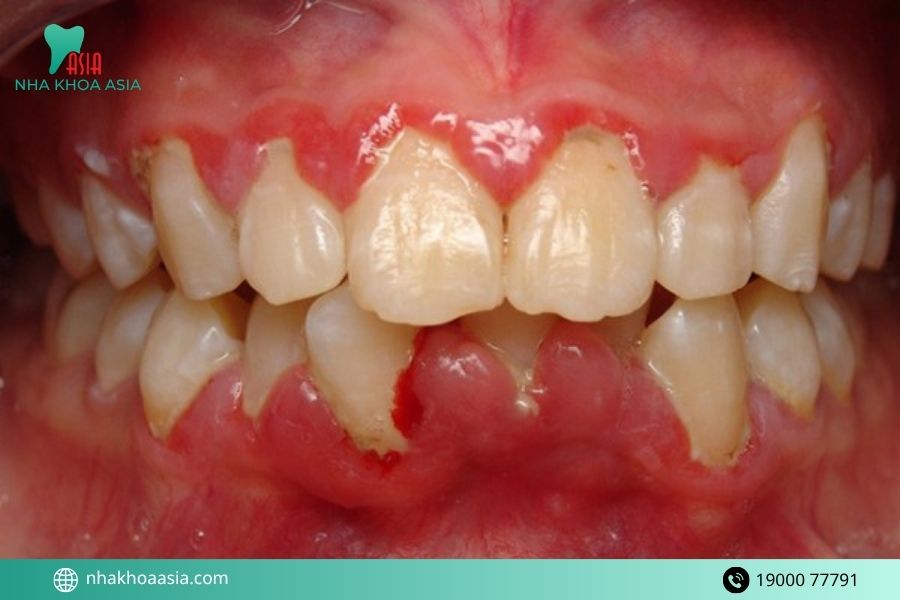 Nguyên nhân gây viêm lợi viêm nha chu phổ biến