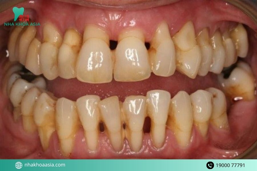 Cách điều trị viêm lợi viêm nha chu theo từng mức độ