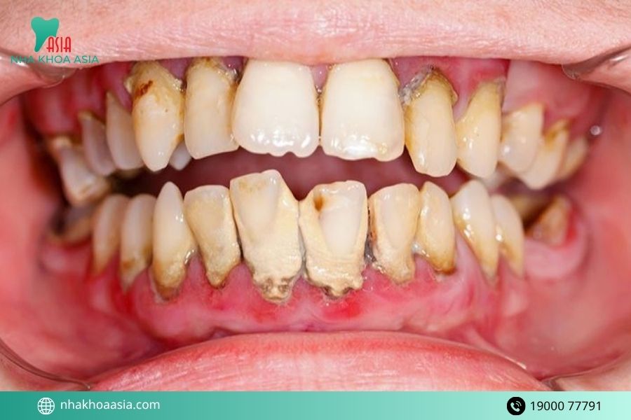 Quy trình điều trị viêm lợi viêm nha chu tại Nha khoa Asia