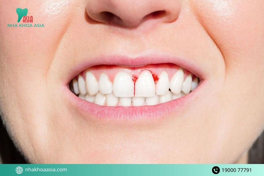 Viêm nướu răng có tự khỏi được không? Bao lâu thì khỏi? 