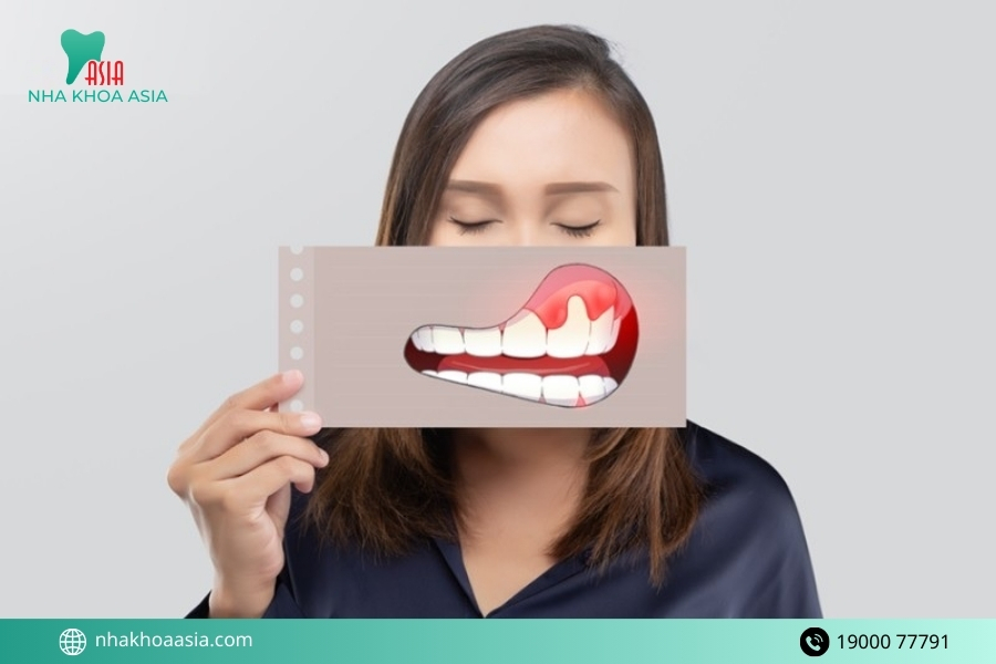 Viêm nướu răng là gì?