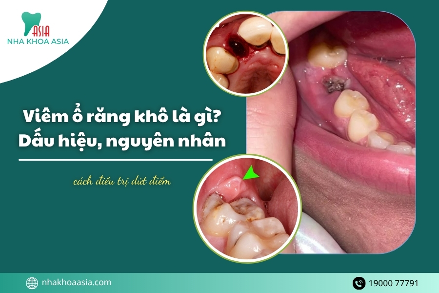 Viêm ổ răng khô là gì? Dấu hiệu, nguyên nhân & cách điều trị dứt điểm