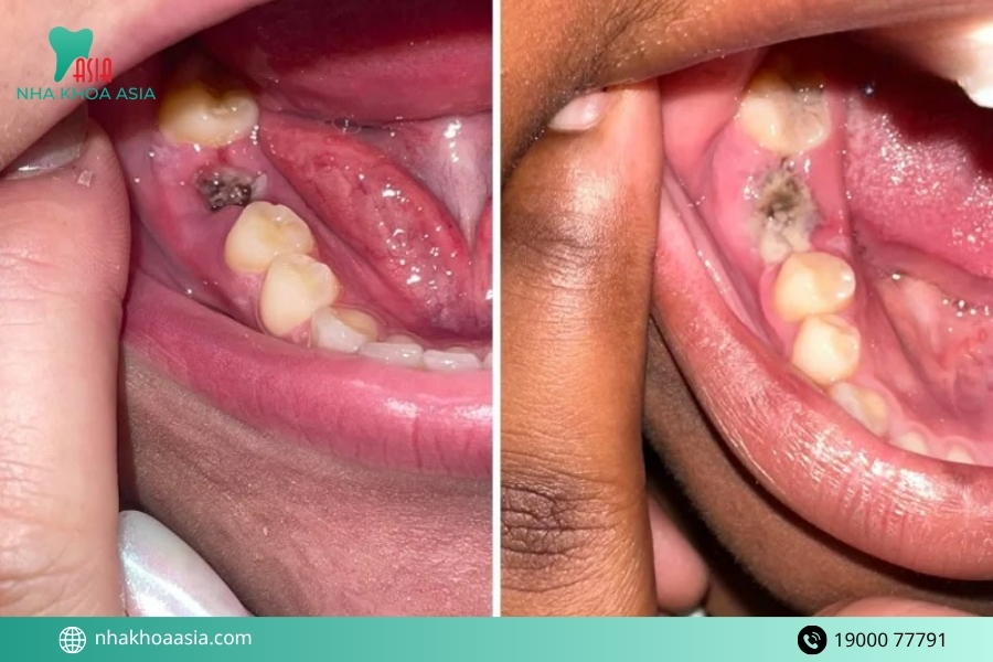 Viêm ổ răng khô là gì? Viêm ổ răng khô có nguy hiểm không?