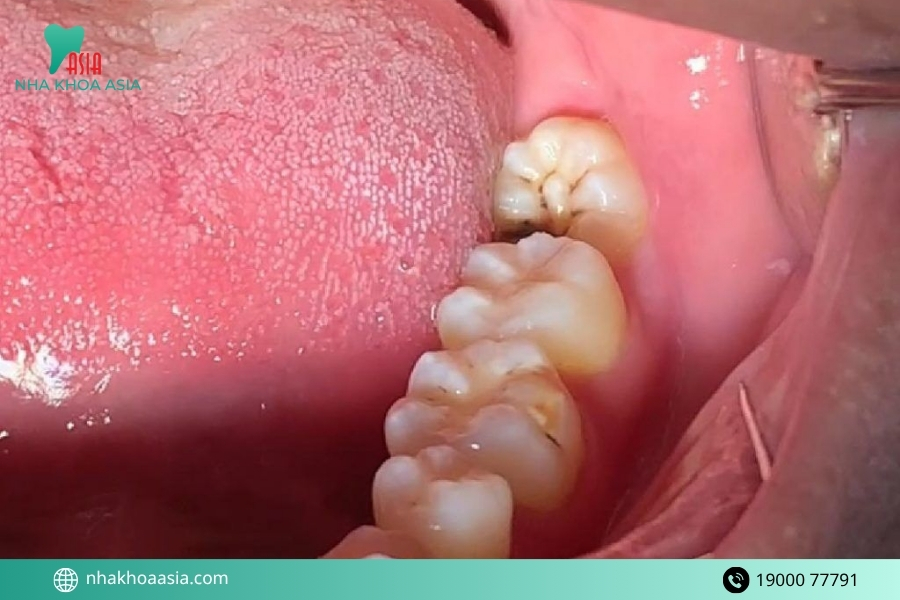 Những cách điều trị viêm ổ răng khô an toàn