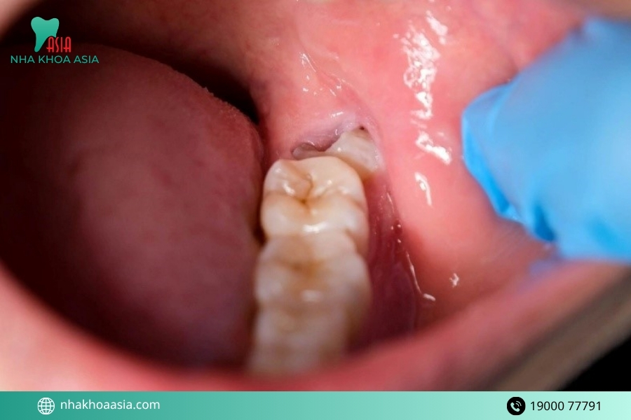 Những việc cần tránh khi bị viêm ổ răng khô