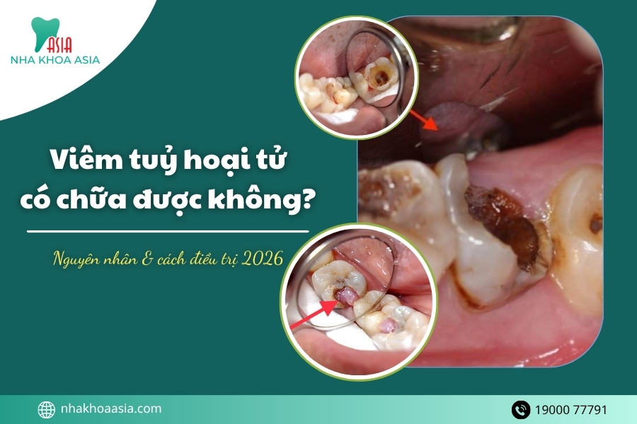 Viêm tuỷ hoại tử có chữa được không? Nguyên nhân & cách điều trị 2026
