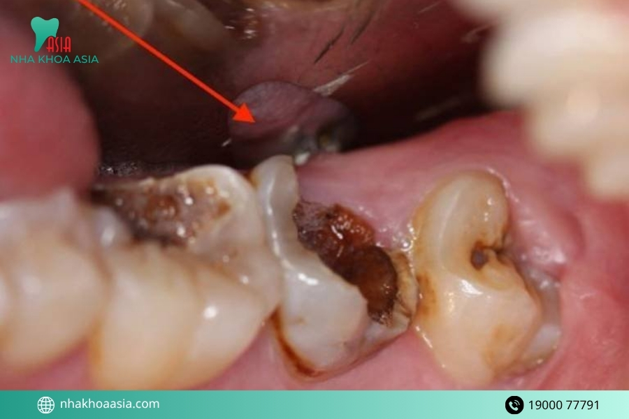 Viêm tuỷ hoại tử có chữa được không?