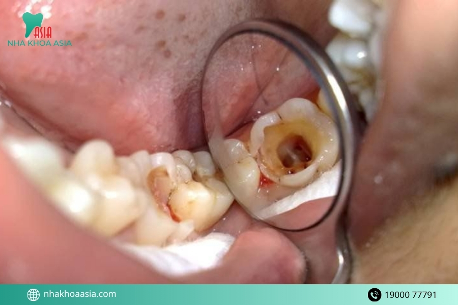 Nguyên nhân dẫn đến bị viêm tuỷ hoại tử