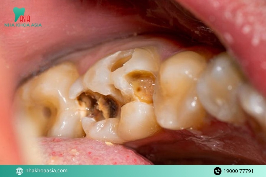 Cách điều trị viêm tuỷ hoại tử hiện nay được chuyên gia tư vấn