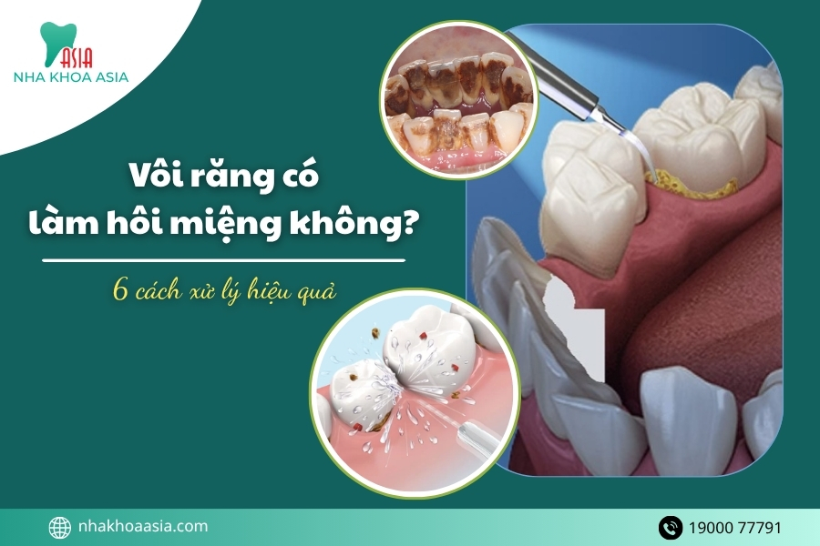 Vôi răng có làm hôi miệng không? 6 cách xử lý hiệu quả