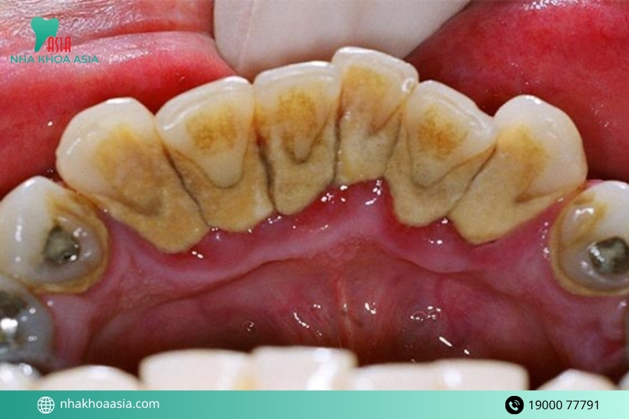 Bao lâu nên lấy vôi răng một lần? Chi phí lấy vôi răng bao nhiêu?