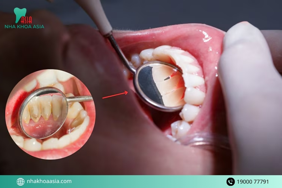 Dấu hiệu nhận biết hôi miệng do vôi răng