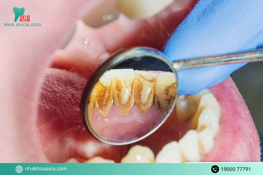 Các nguyên nhân gây hôi miệng phổ biến khác