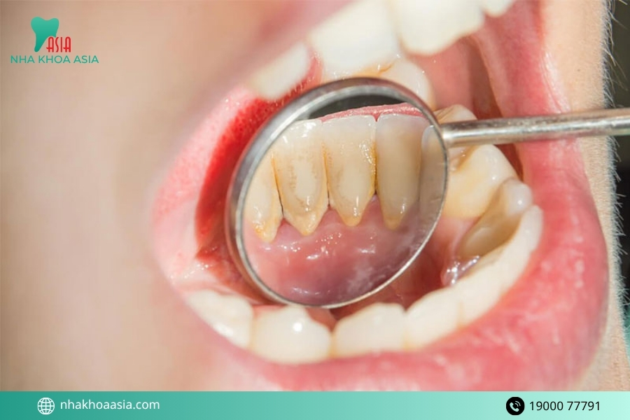 6 cách xử lý hôi miệng do vôi răng hiệu quả