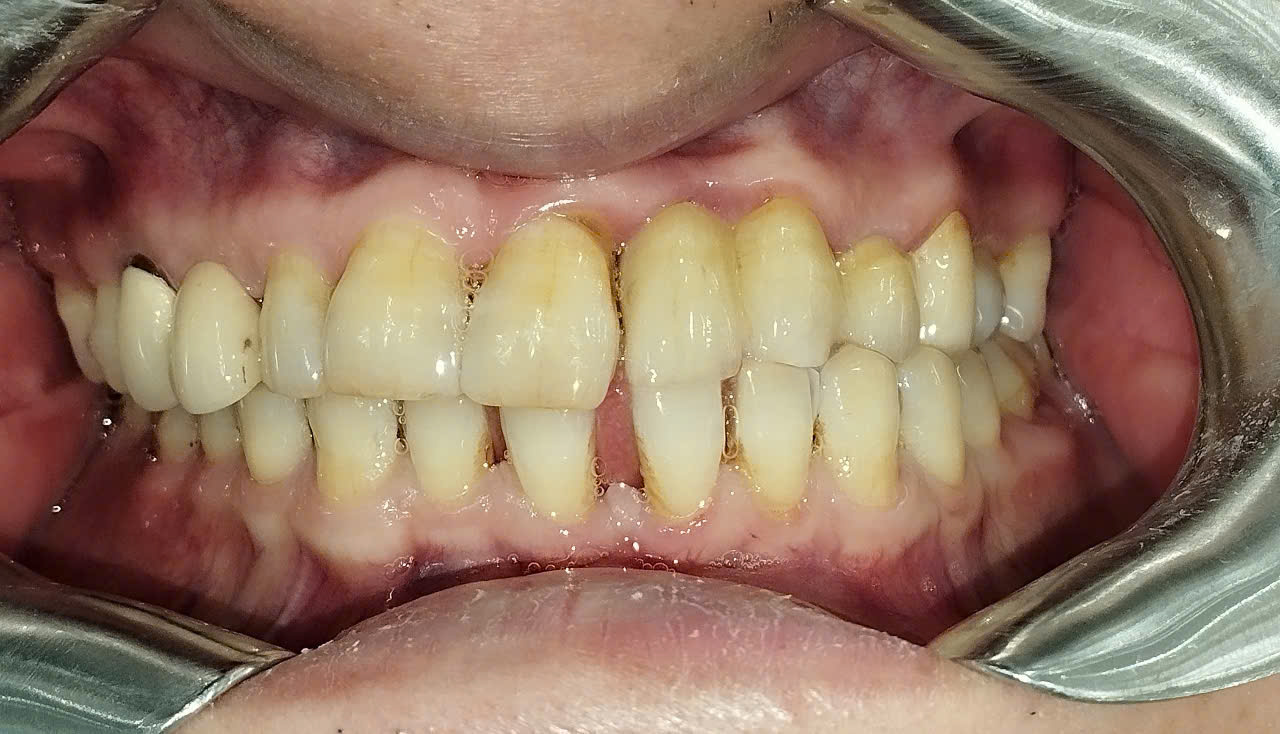 Men răng giúp bảo vệ bề mặt răng