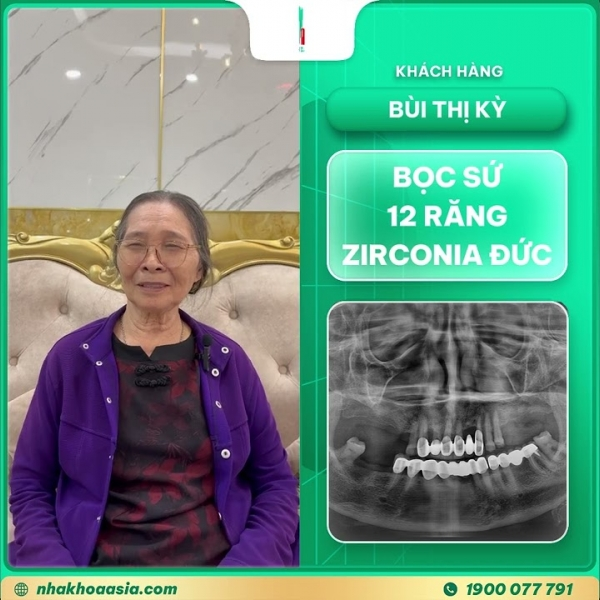 Cảm nhận khách hàng bọc 12 răng sứ zirconia Đức - Cô Bùi Thị Kỳ | Nha khoa Asia