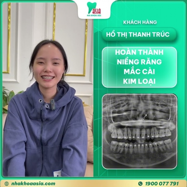 Cảm nhận khách hàng Hồ Thị Thanh Trúc niềng răng mắc cài kim loại | Nha khoa asia