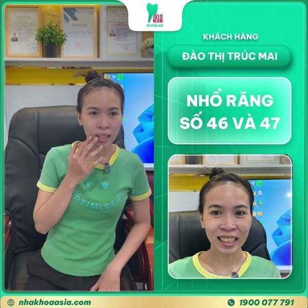 Đào Thị Trúc Mai đã đến Nha khoa Asia để thực hiện nhổ răng số 46 và 47 do răng bị sâu