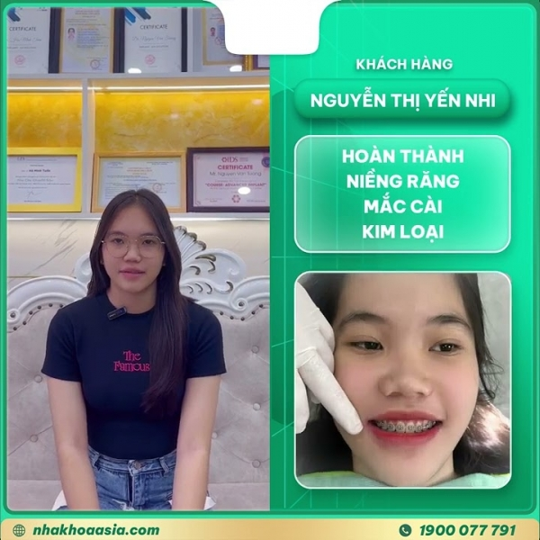 Niềng răng mắc cài kim loại của khách hàng Nguyễn Thị Yến Nhi tại Nha Khoa Asia