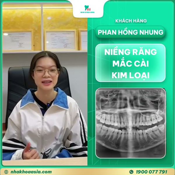 Cảm nhận khách hàng Phan Hồng Nhung khi niềng răng mắc cài kim loại tại Nha Khoa Asia