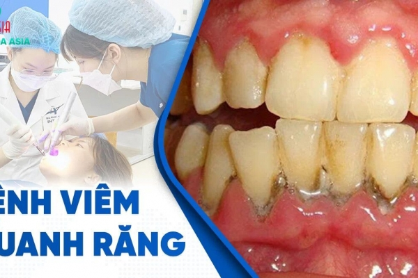 Viêm quanh răng: Nguyên nhân, triệu chứng và lời khuyên của bác sĩ