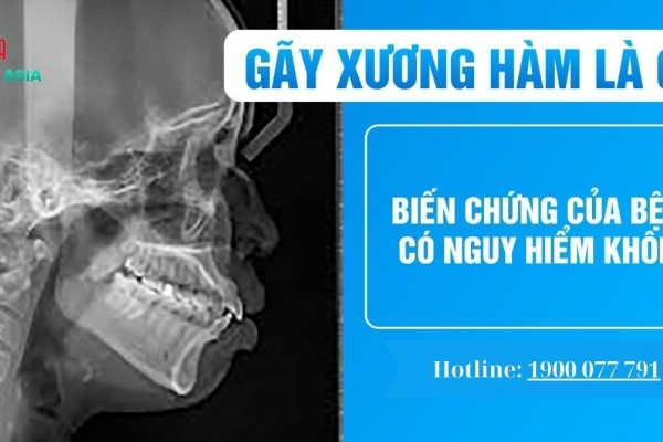 Gãy xương hàm: Bác sĩ hướng dẫn cách điều trị
