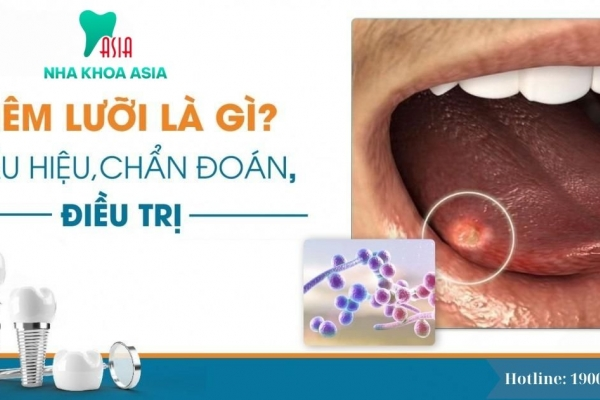 Viêm lưỡi là gì? Triệu chứng của bệnh, bác sĩ dành lời khuyên