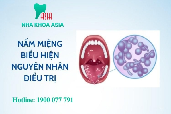 Nấm miệng: Triệu chứng, nguyên nhân, phương pháp điều trị