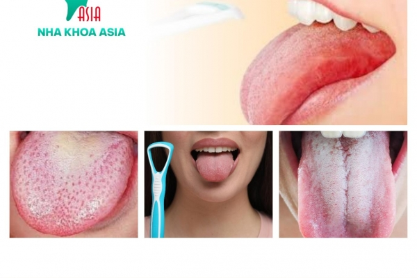 Bệnh lưỡi trắng là gì - Nguyên nhân và cách trị bệnh lưỡi trắng hiệu quả [Bạn đã biết]