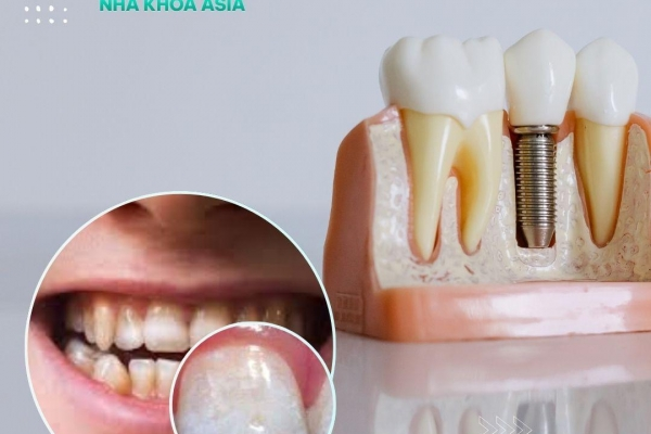 Thiểu sản men răng: Dấu hiệu, nguyên nhân và cách điều trị hiệu quả [2025]