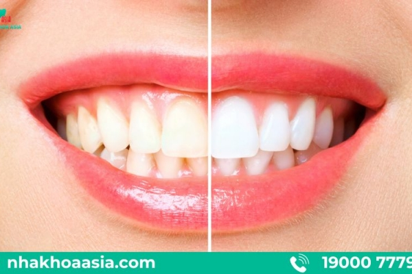 Tẩy trắng răng giá rẻ có tốt không? Bác Sĩ Nguyễn Văn Tưởng chia sẻ