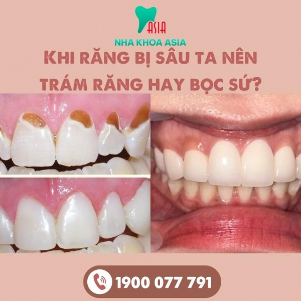 Khi răng bị sâu ta nên trám răng hay bọc sứ? Tư vấn từ chuyên gia