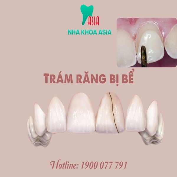 Những điều cần biết về phương pháp trám răng bị bể