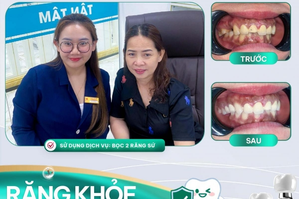 Chị Huỳnh Hương - Bọc răng sứ thẩm mỹ