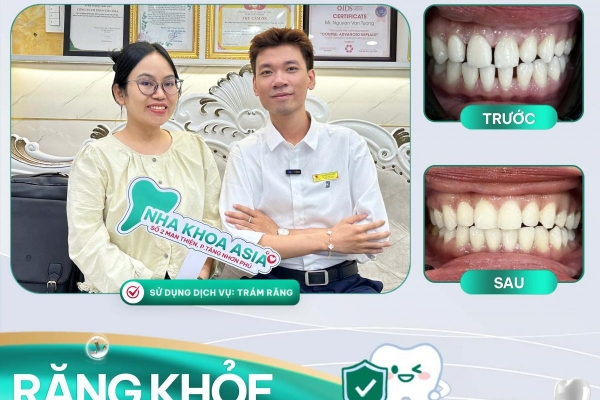 Chị Thiên Quyên - Trám răng thẩm mỹ