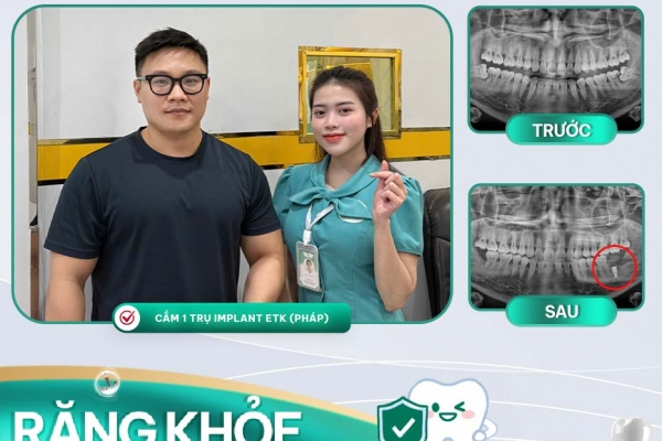 Dịch vụ Trồng Răng Implant Tại Nha Khoa Asia – Giải Pháp Hoàn Hảo Cho Nụ Cười Tự Tin