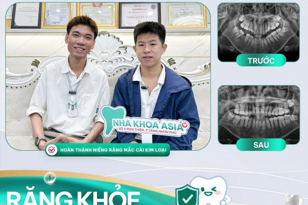  Dịch Vụ Niềng Răng Tại Nha Khoa Asia – Hành Trình Tìm Lại Nụ Cười Tự Tin