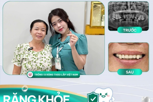 Dịch Vụ Làm Hàm Giả Tháo Lắp Tại Nha Khoa Asia