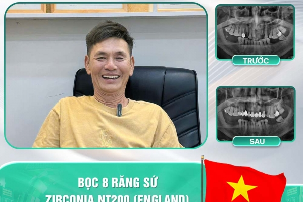  Bọc Răng Sứ Thẩm Mỹ Tại Nha Khoa Asia – Giải Pháp Hoàn Hảo Cho Nụ Cười Tự Tin