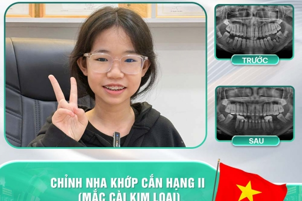 Cảm nhận khách hàng sau khi niềng răng tại Nha khoa Asia
