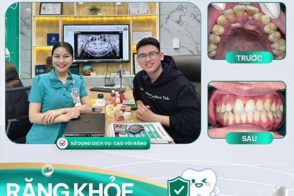 Vôi răng là gì? Tại sao cần cạo vôi răng định kỳ?