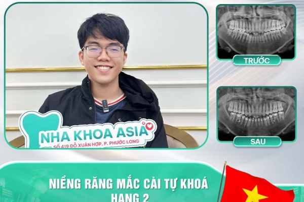 Niềng răng mắc cài kim loại tự khóa - Giải pháp hoàn hảo cho nụ cười chuẩn đẹp